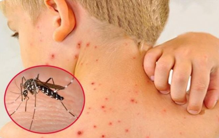 Bảo Vệ Gia Đình Trước Dịch Bệnh Chikungunya – Tại Sao Cửa Lưới Chống Muỗi Là Giải Pháp Cấp Bách Nhất Hiện Nay?